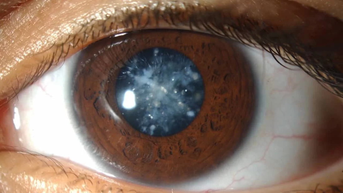 Ce trebuie sa stim despre cataracta si care sunt cauzele aparitiei acesteia